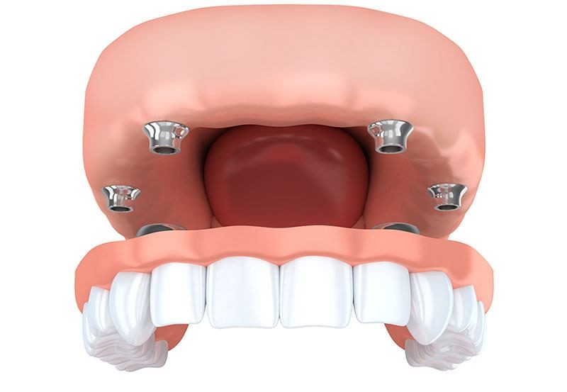 Before And After 
      Dentures Spurgeon IN 47584